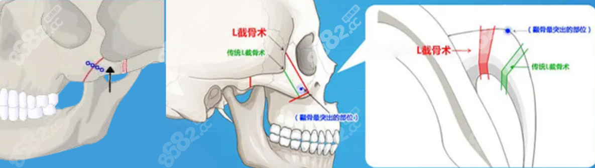 双L截骨