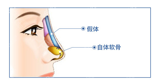 全肋软骨鼻和半肋软骨鼻的区别