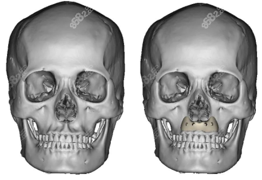 peek3d打印鼻基底优势