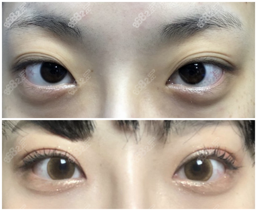 大眼睛整形外科眼修复对比