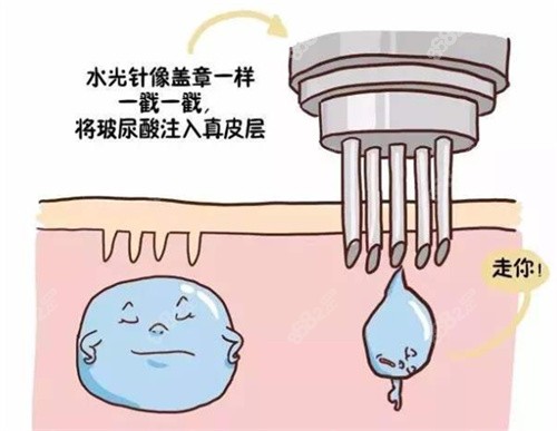 水光注射嫩肤原理