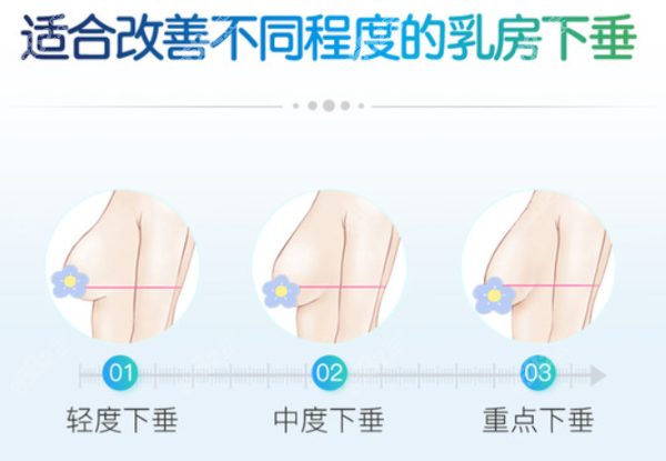 单侧轻度乳房不对称可做假体隆胸改善