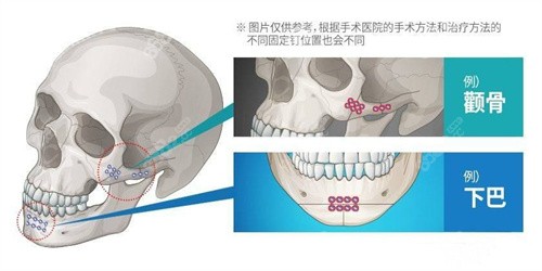 钛板位置示例图