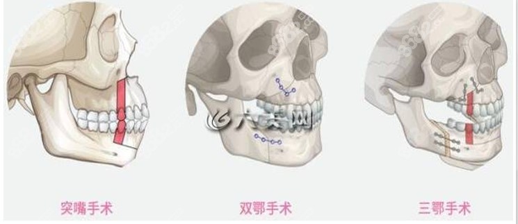 正颌手术方式图解