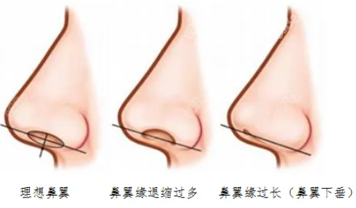 鼻翼缘退缩图示