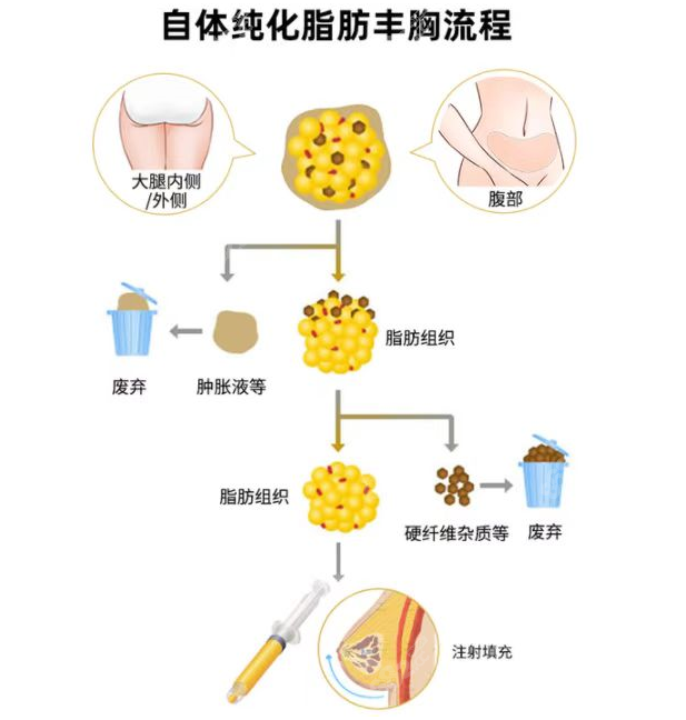 自体脂肪丰胸过程图www8682cc