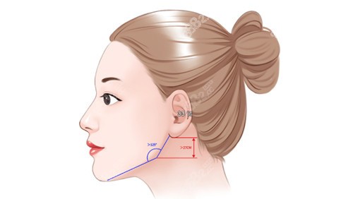 下颌角切除后角度小线条更流畅