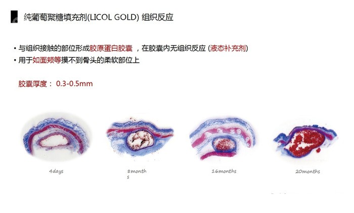 注射葡聚糖隆鼻后形成的胶原胶囊避免吸收