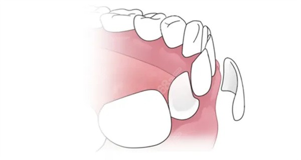 牙贴面的适应症和优缺点
