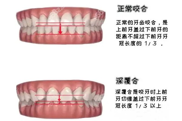 覆合的定以及分度