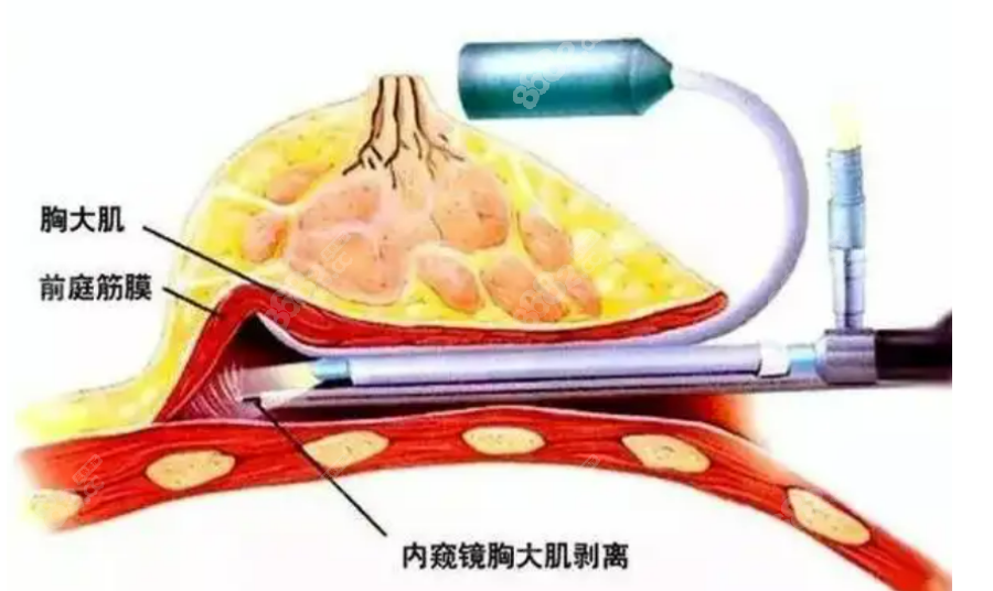 曹孟君医生隆胸8682.cc