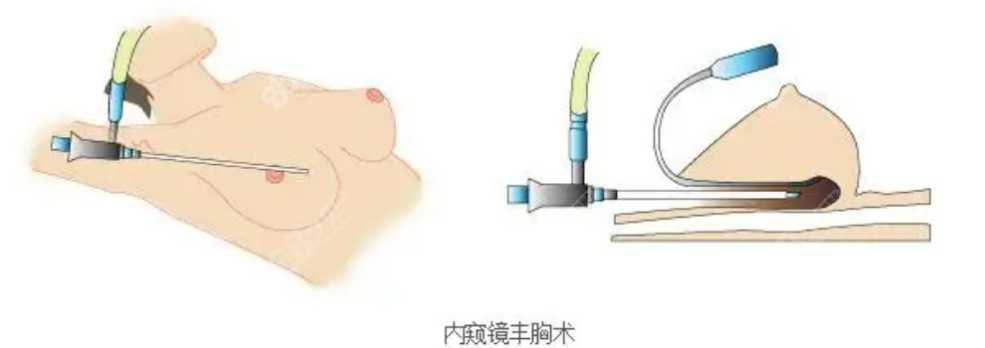 曹孟君医生做假体隆胸手术