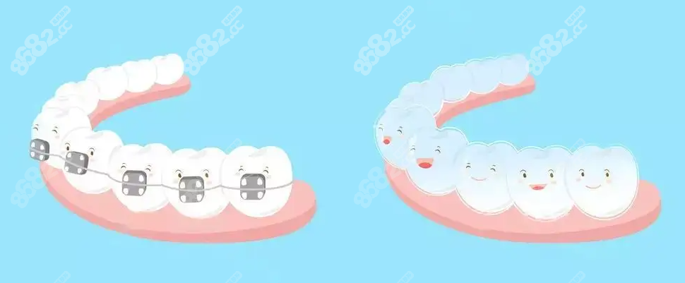 金属矫正和隐形矫正示意图