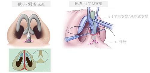 厦门欧菲鼻小柱支撑技术