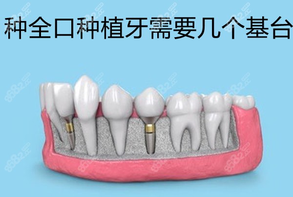 种全口种植牙需要几个基台