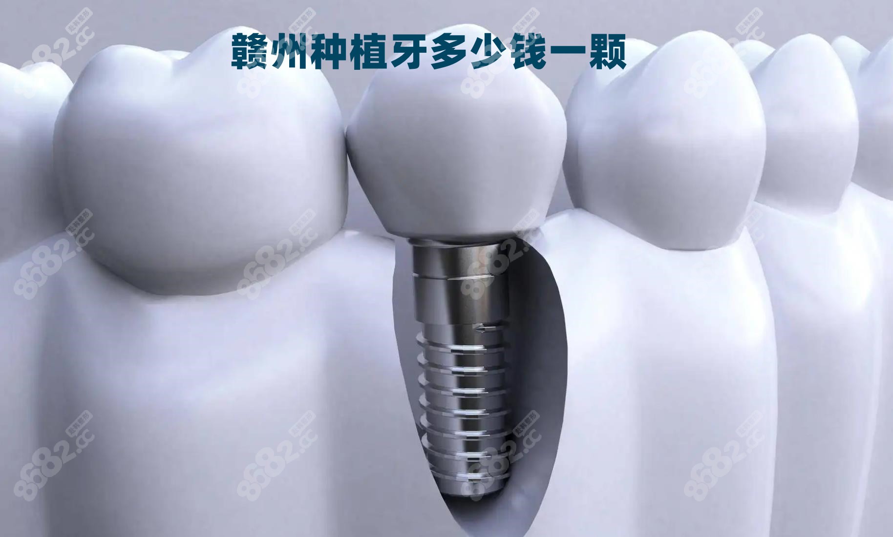 赣州种植牙价格8682.cc
