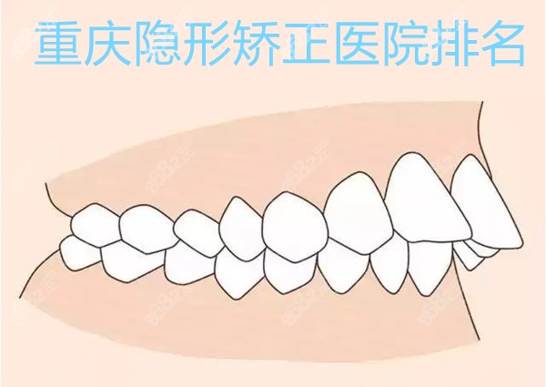 重庆隐形矫正医院排名