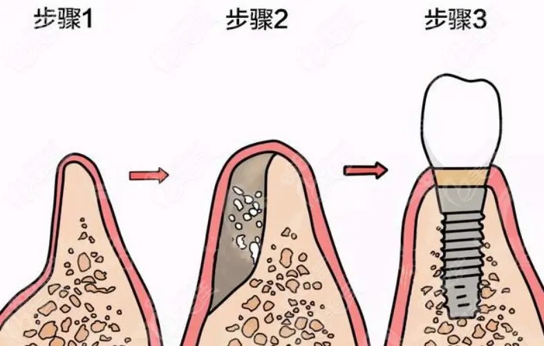 牙槽骨植骨怎么样植