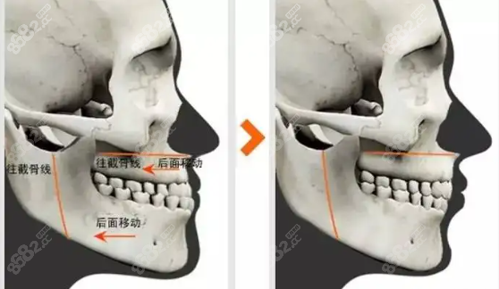 下颌骨手术全过程8682.cc