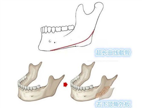 超长曲线下颌角截骨