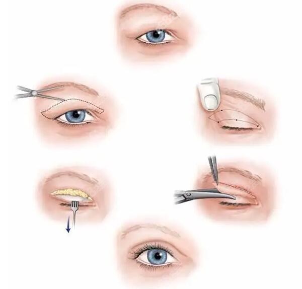 韩国眼部整形医院排名,这几家割双眼皮和眼修复技术很不错