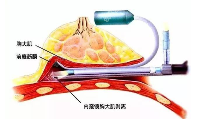 内窥镜隆胸特点