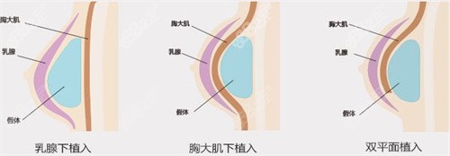 双平面隆乳术与其他的不同