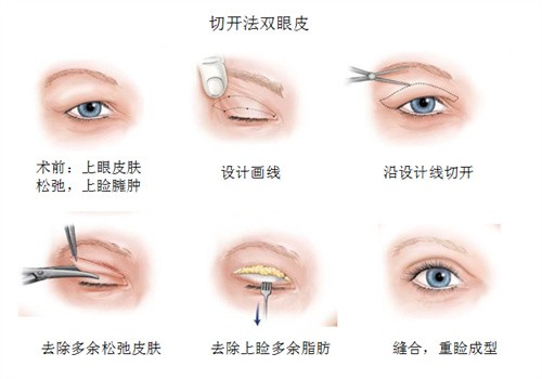 切开双眼皮手术示意图