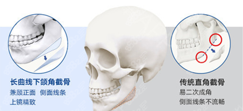 长曲线下颌角和传统截骨手术区别