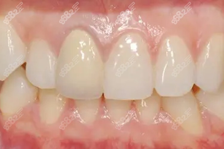 正常牙龈和牙龈萎缩照片,年轻人牙龈萎缩自愈吗