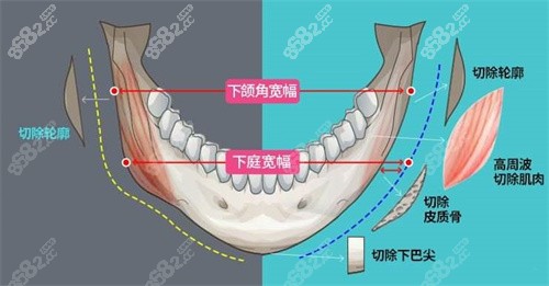 下颌角磨骨图解