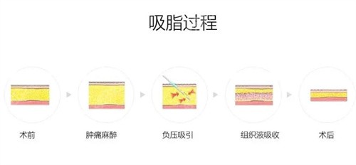 脂肪抽吸过程示意