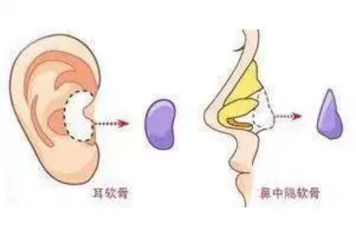 隆鼻技术优势