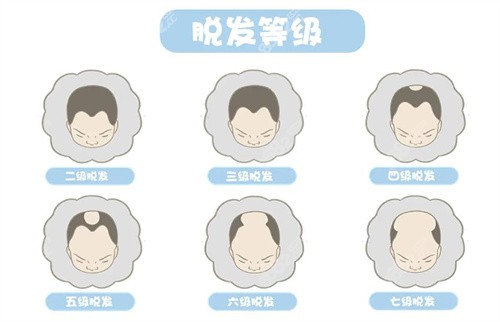 脱发等级自测表