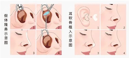 隆鼻技术优势