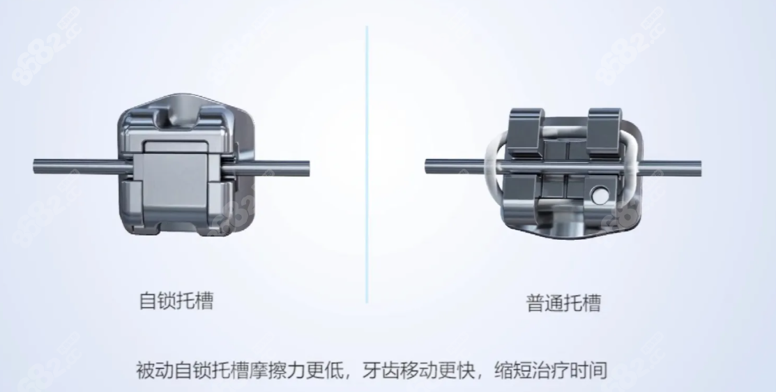 金属自锁与普通托槽对比