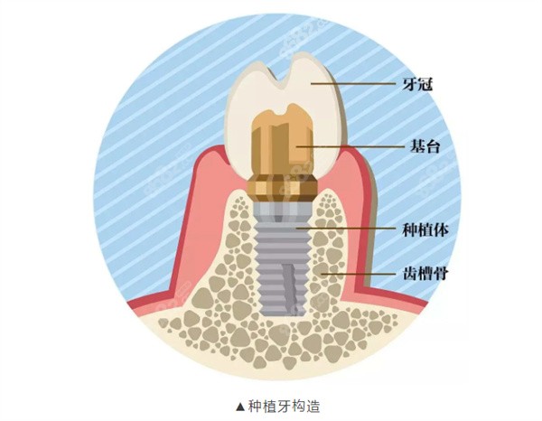 种植牙的组成及构造