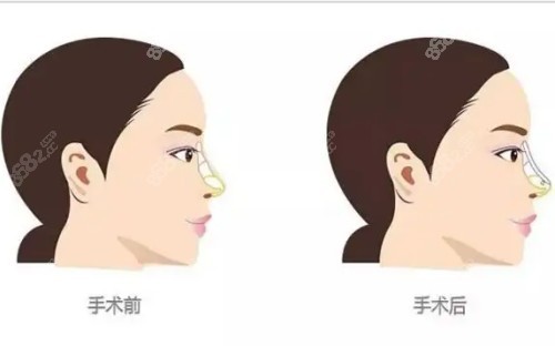 客户隆鼻后反馈