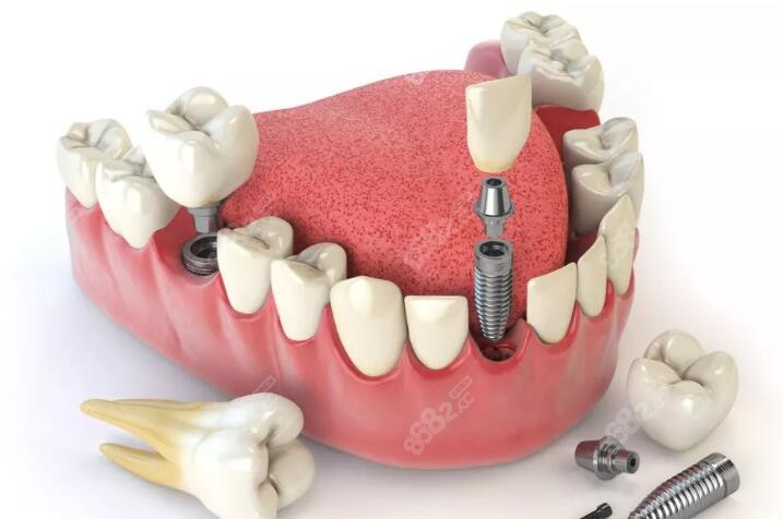 张家界博瑞口腔价格是6800-16000元起