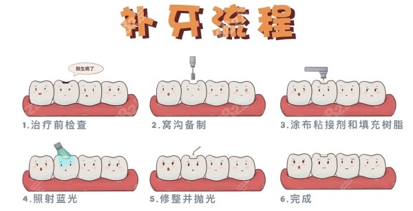 补牙流程示意图