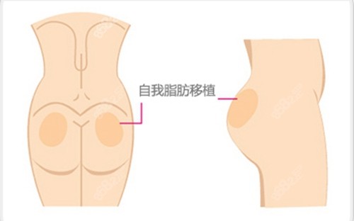 韩国必当归医院丰臀手术优势