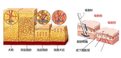 土麦森吸脂去除富贵包手术过程