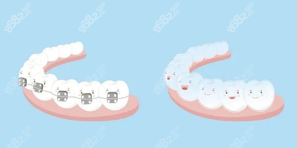 牙套不同材质舒适度都不同