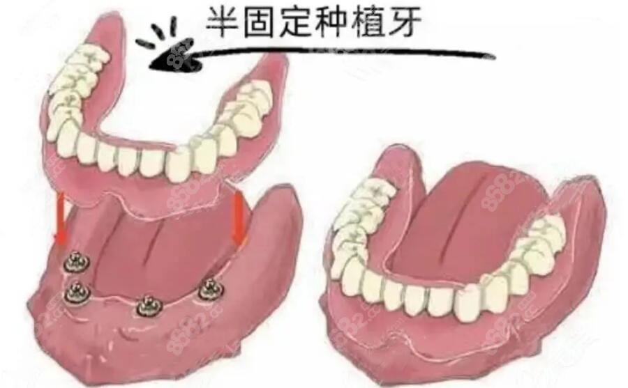 什么叫半固定种植牙？