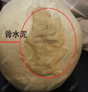 骨水泥填充后脑勺价格贵不贵m.8682.cc