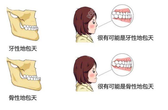 骨性地包天和牙性地包天对比图