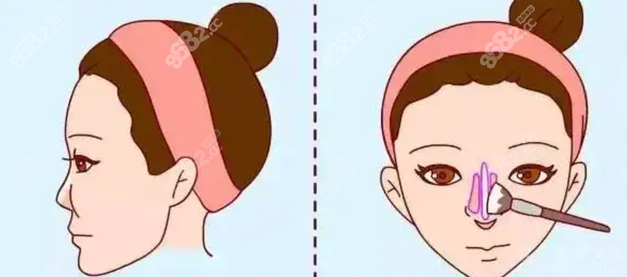 做鼻子失败了别担心可以修复好