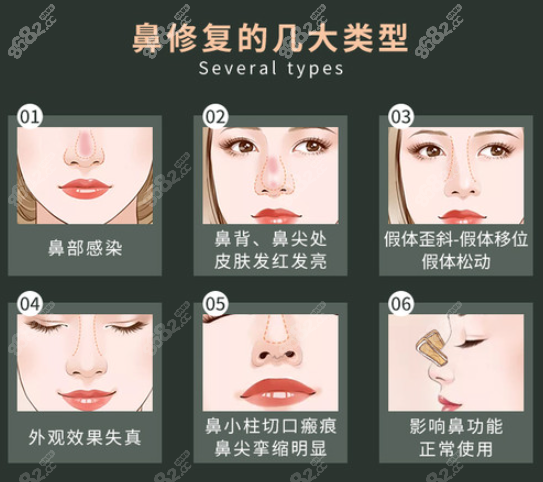 鼻假体移位外漏怎么修复