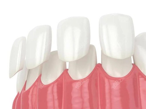 武汉牙齿贴面价格查询表:做树脂/全瓷/冰瓷贴面牙齿美白800+
