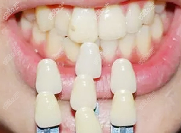 牙齿比色的图www.8682.cc